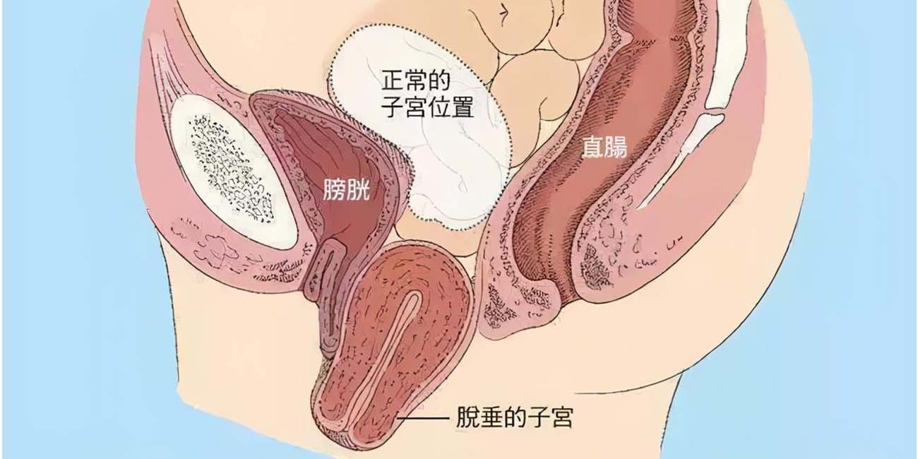 产后脏器脱垂会有什么症状？这2种修复方式值得收藏，早发现早治疗