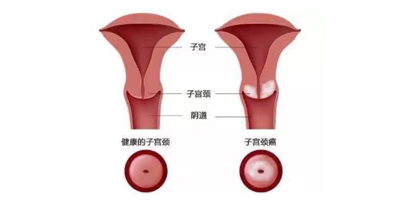 宫颈癌是什么原因引起的？这4种预防手段，很多人都遗漏了