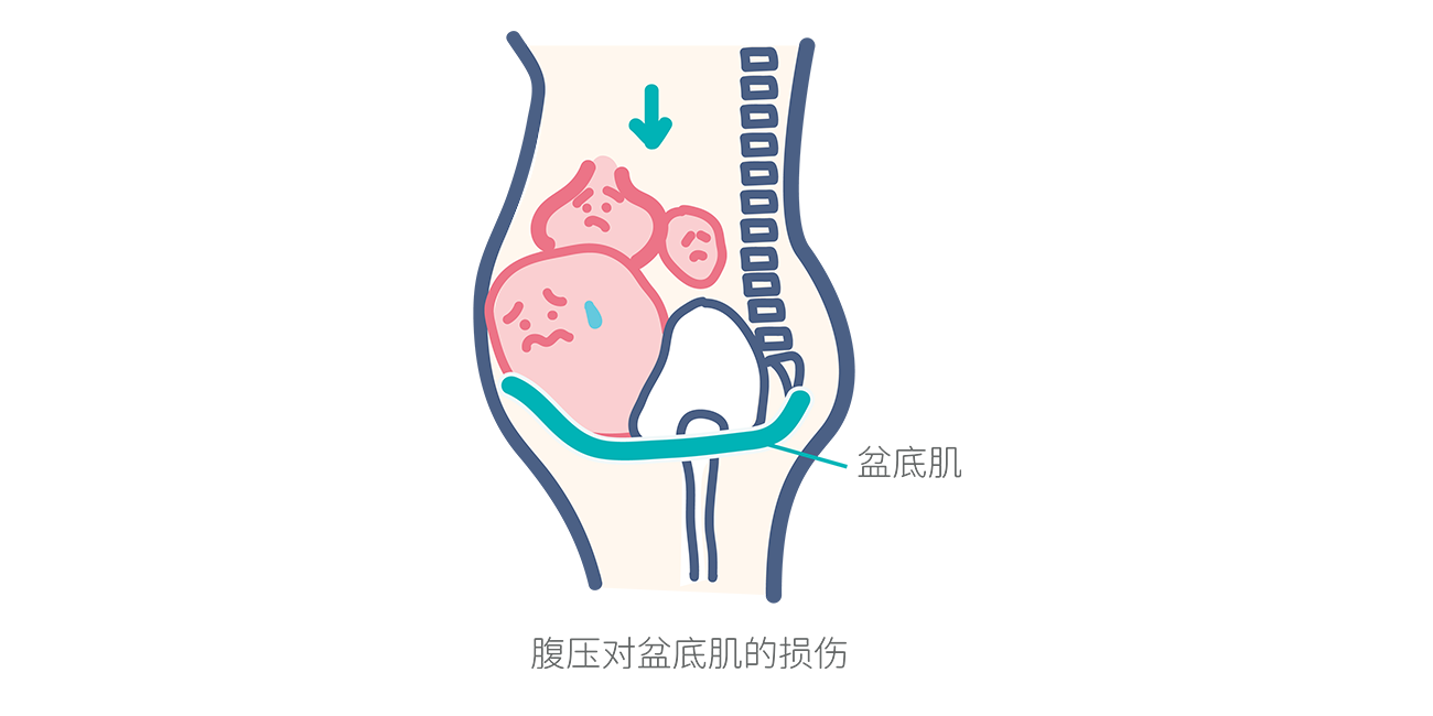 一文读懂盆底问题的症状表现、诱发原因与修复方式