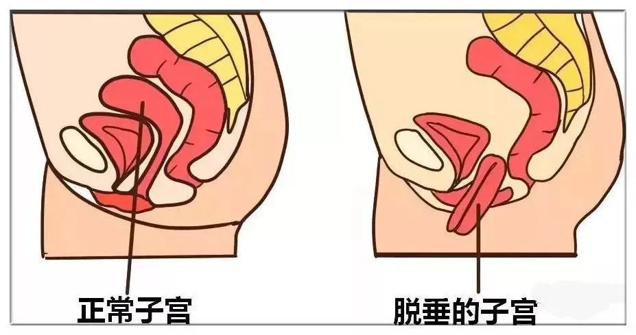 重阳节，关注中老年女性的盆底健康(图3)