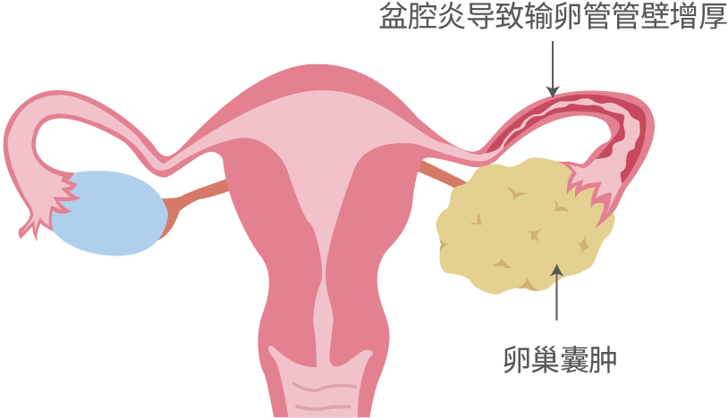 下腹痛、同房痛、白带月经异常...卵巢囊肿怎么办？能做盆底康复吗？