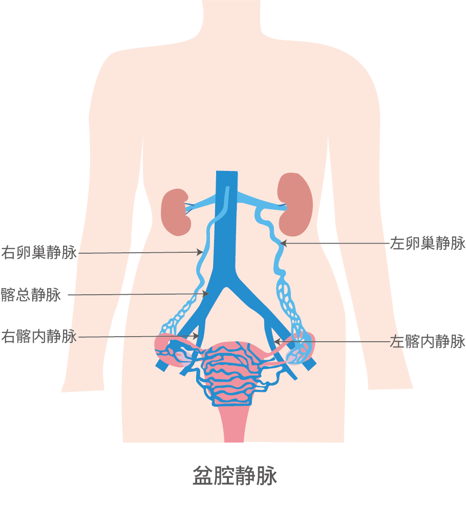 产后盆腔淤血综合征频发？电刺激生物反馈等疗法汇总！