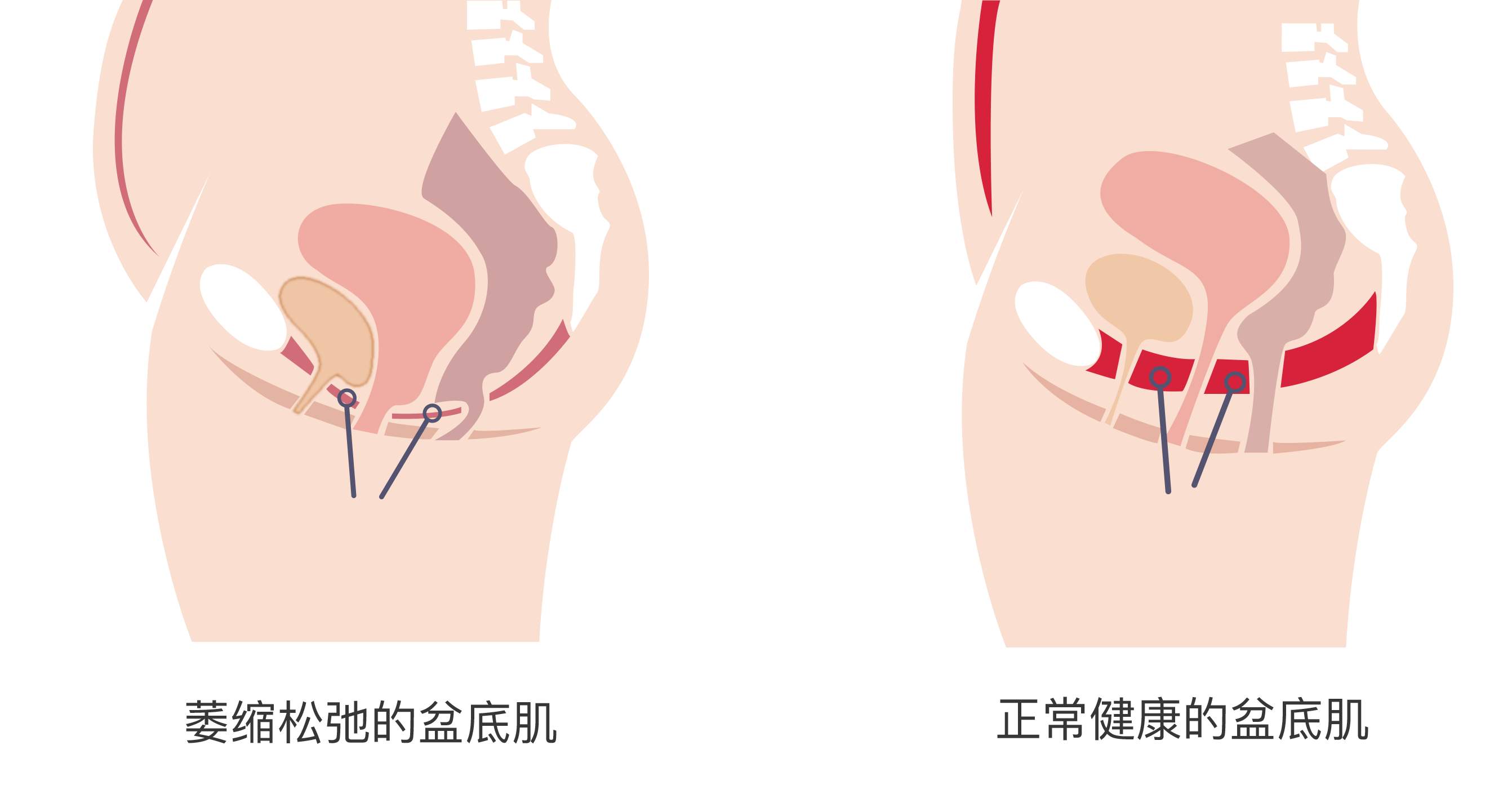 做完盆底肌康复治疗后,为什么会出血?注意这7个原因(图1) 做完盆底肌康复治疗后,为什么会出血?注意这7个原因(图1)