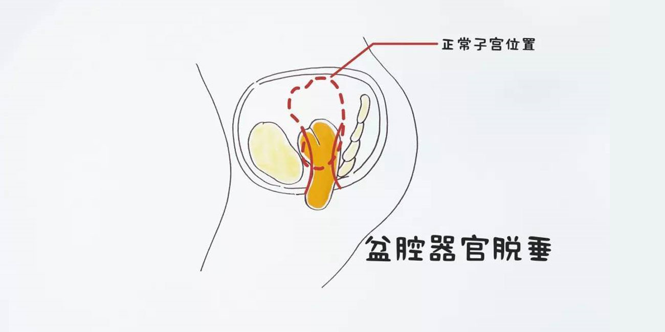 盆腔脱垂 | 从裤子里掉下来的无奈(图2) 盆腔脱垂 | 从裤子里掉下来的无奈(图2)