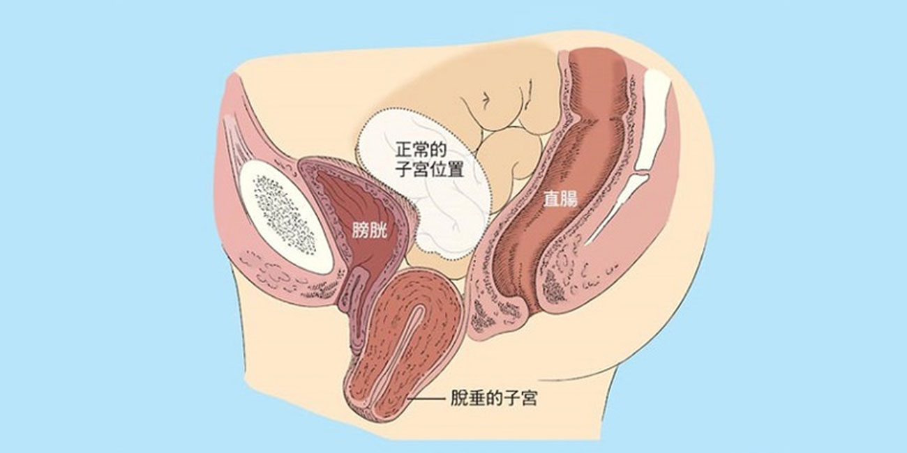 盆腔脱垂 | 从裤子里掉下来的无奈(图3) 盆腔脱垂 | 从裤子里掉下来的无奈(图3)