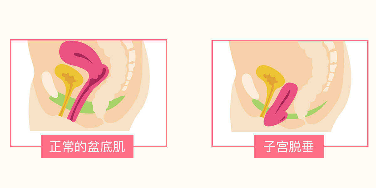 为什么产后下面会下垂?日常生活中应该要注意这3种情况(图2) 为什么产后下面会下垂?日常生活中应该要注意这3种情况(图2)