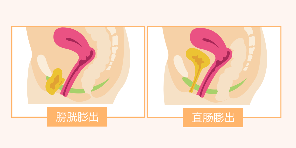 为什么产后下面会下垂?日常生活中应该要注意这3种情况(图1) 为什么产后下面会下垂?日常生活中应该要注意这3种情况(图1)