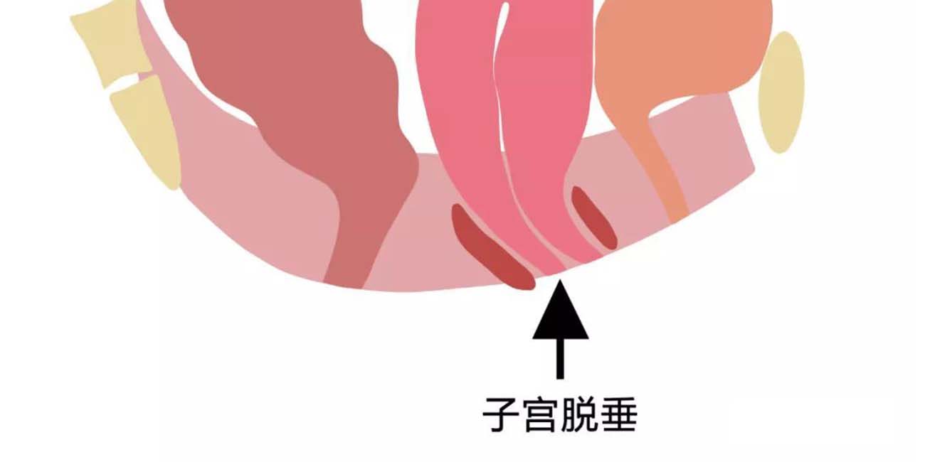 产后脏器脱垂会有什么症状?这2种修复方式值得收藏,早发现早治疗(图2) 产后脏器脱垂会有什么症状?这2种修复方式值得收藏,早发现早治疗(图2)