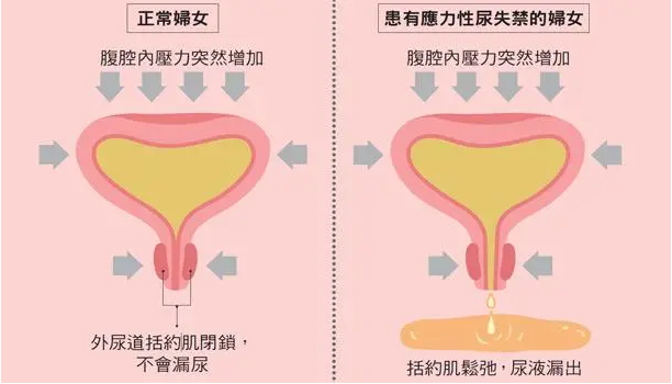 压力性尿失禁
