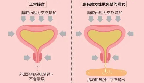 生完娃很多年,还要不要做盆底康复?(图3) 生完娃很多年,还要不要做盆底康复?(图3)